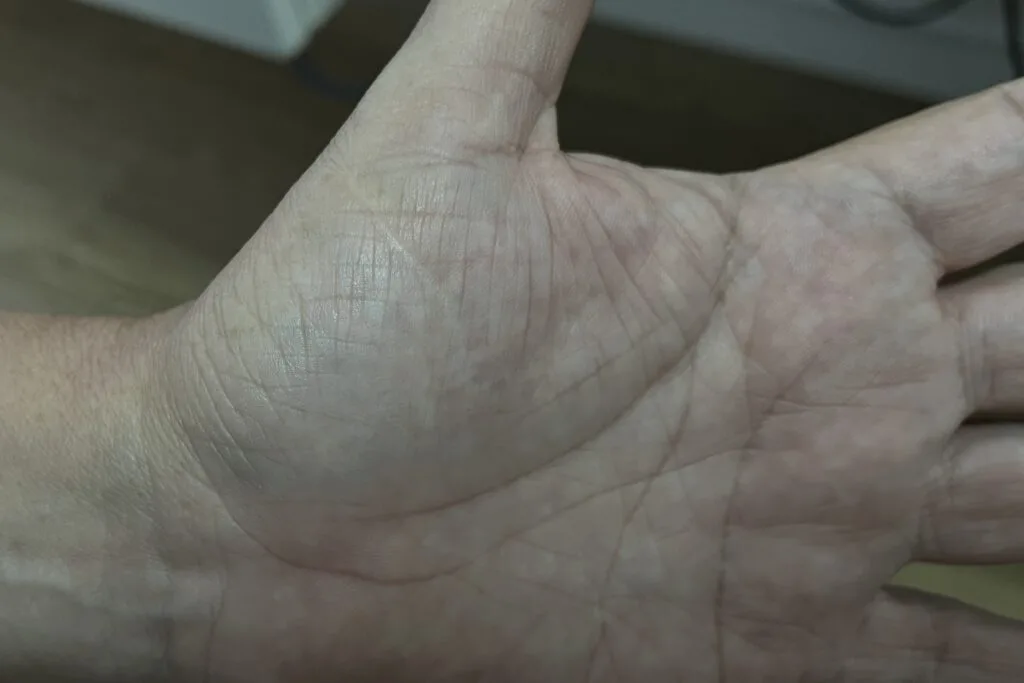 Mão com cicatriz