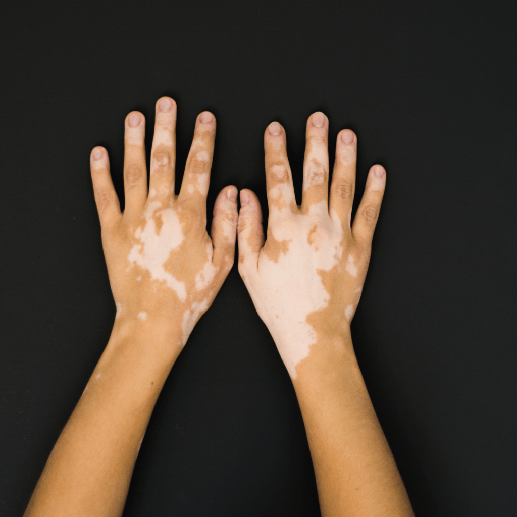 SES-AM.01_Dia-dos-portadores-de-vitiligo_.png